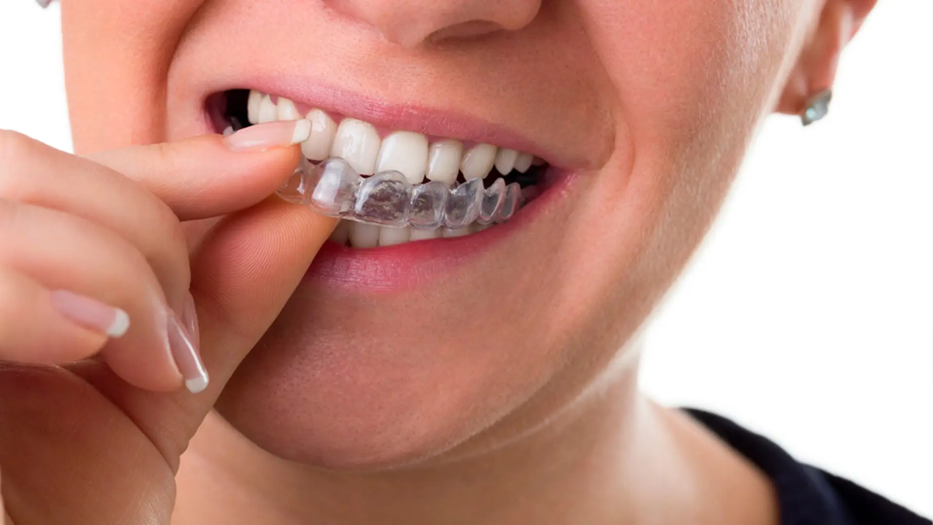 Beneficios de la ortodoncia invisible