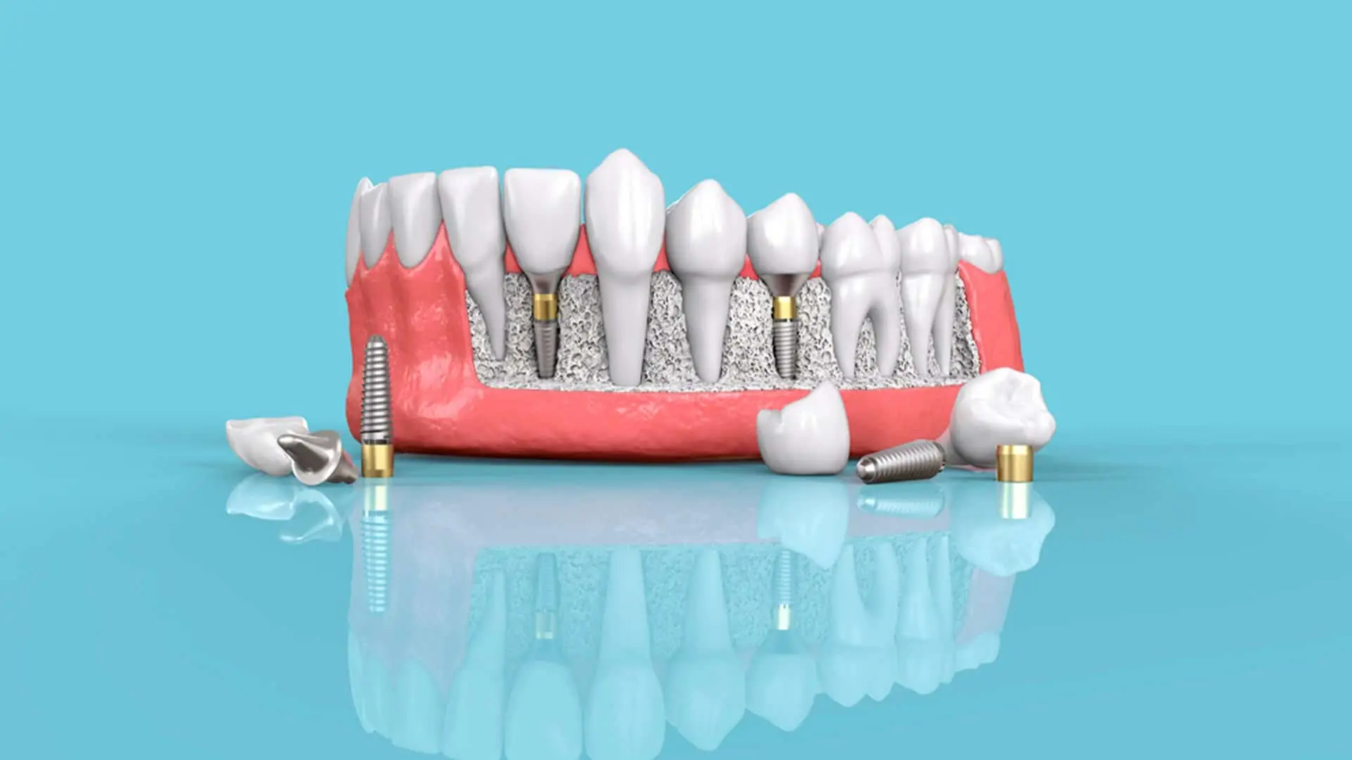 Beneficios que debes conocer sobre los implantes dentales Straumann